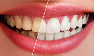 How to Naturally Whiten Yellow Teeth in Photoshop